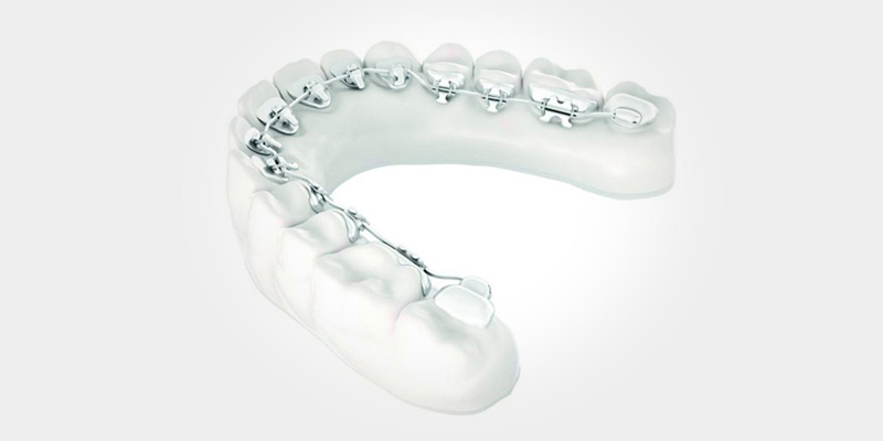 WiN lingual braces at Maybrook Clinic in Soho